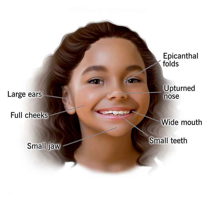 What’s the name of this uncommon syndrome?