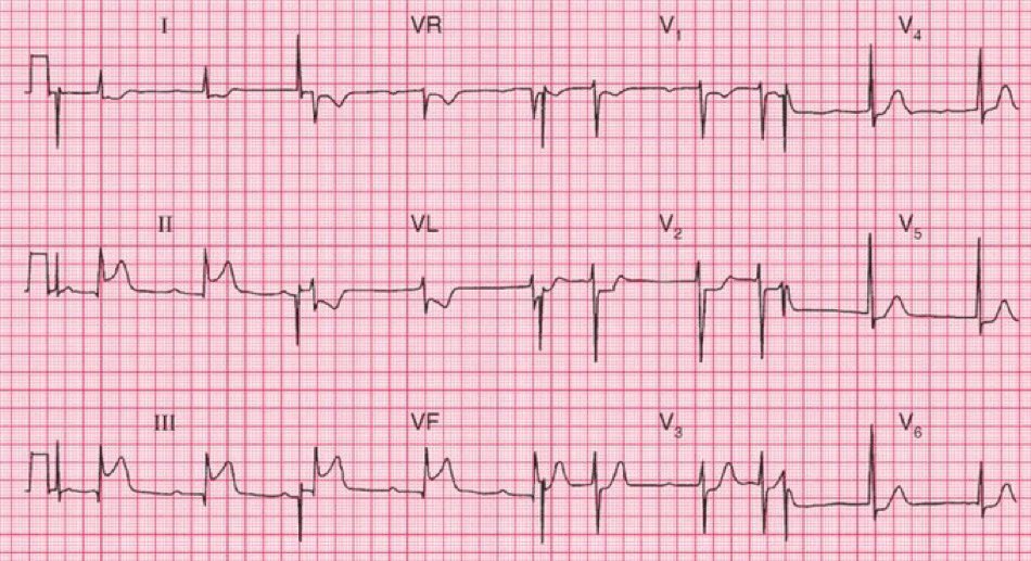 BrownJHM's tweet photo. A 55 y.o. man with severe central chest pain that had been present for about an hour. He was pale, cold and clammy. What does this ECG show?
@ManualOMedicine #medEd https://t.co/u8xxBKpXxU