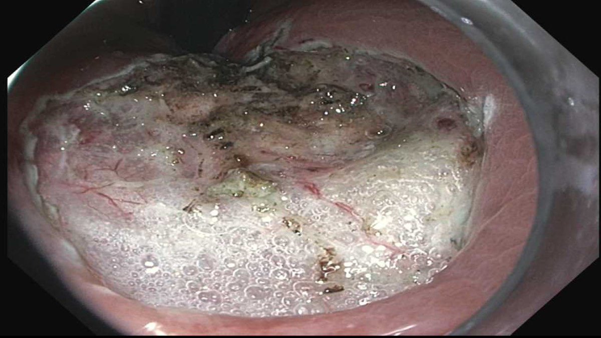 Vishnu Kumar (@dr_vishnukumar) on Twitter photo Unbelievable feeling. My first steps in learning ESD this past week. Iโm grateful to learn from this incredible teacher and supremely talented endoscopist <a href="/MuzaffarAkbar/">Hafiz Muzaffar Akbar Khan</a> at <a href="/UpstateGastro/">Upstate Gastroenterology</a>. More ๐
#GITwitter Unbelievable feeling. My first steps in learning ESD this past week. Iโm grateful to learn from this incredible teacher and supremely talented endoscopist <a href="/MuzaffarAkbar/">Hafiz Muzaffar Akbar Khan</a> at <a href="/UpstateGastro/">Upstate Gastroenterology</a>. More ๐
#GITwitter