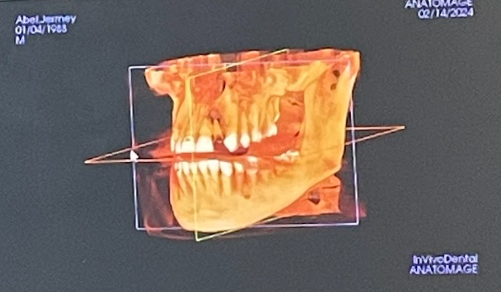 jeez, just got the news from my dentist: I'm a cheese skeleton...