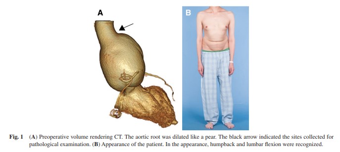 ATCS_journal's tweet photo. Officially Published in Vol. 30, Issue 1
Scattered Media Elastic Fibers from the Aortic Root to the Ascending Aorta in a 30-Year-Old Marfan Syndrome Patient ... https://t.co/ddF75oT5Qr
#Marfansyndrome, #aorticrootdilation, #elasticfiber https://t.co/GW6wF1WVfr