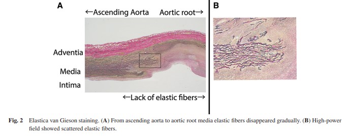 ATCS_journal's tweet photo. Officially Published in Vol. 30, Issue 1
Scattered Media Elastic Fibers from the Aortic Root to the Ascending Aorta in a 30-Year-Old Marfan Syndrome Patient ... https://t.co/ddF75oT5Qr
#Marfansyndrome, #aorticrootdilation, #elasticfiber https://t.co/GW6wF1WVfr
