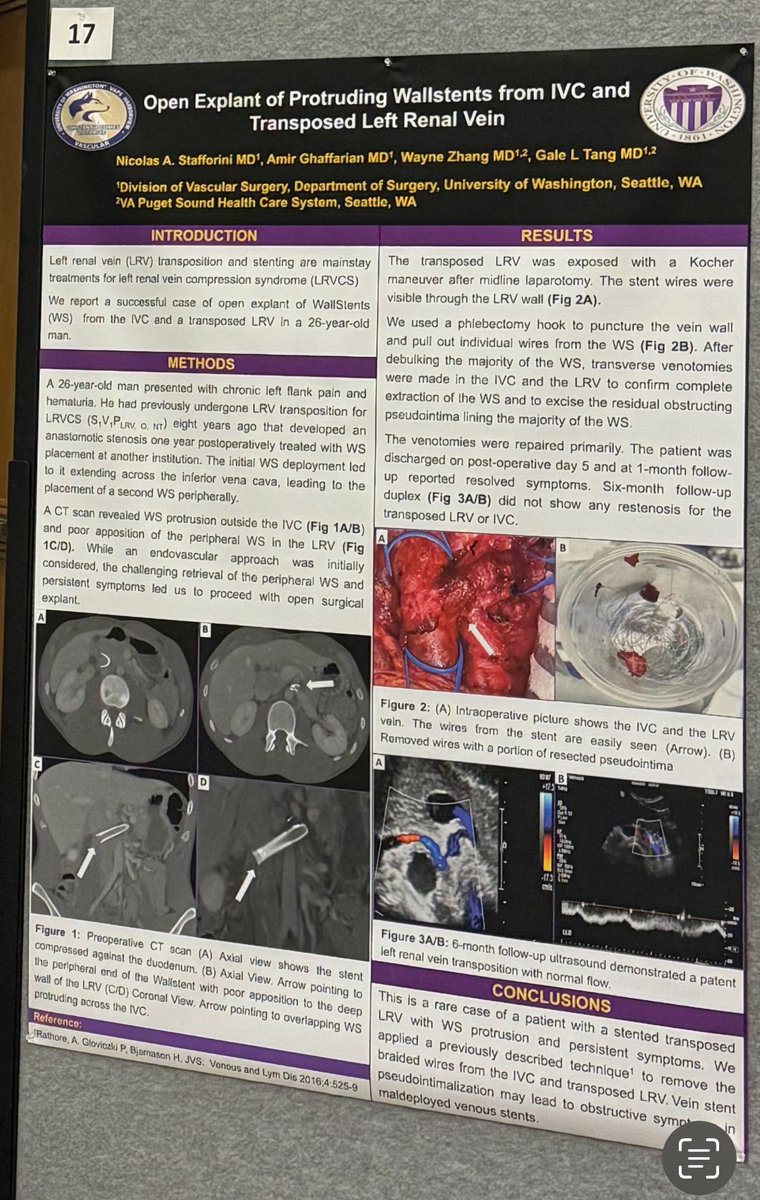 Dr Stafforini presenting at the Strandness poster session a challenging case of open explant of protruding Wallstent and transposed renal vein @NicoStafforini @GaleTang @amirgh26 @StrandnessS