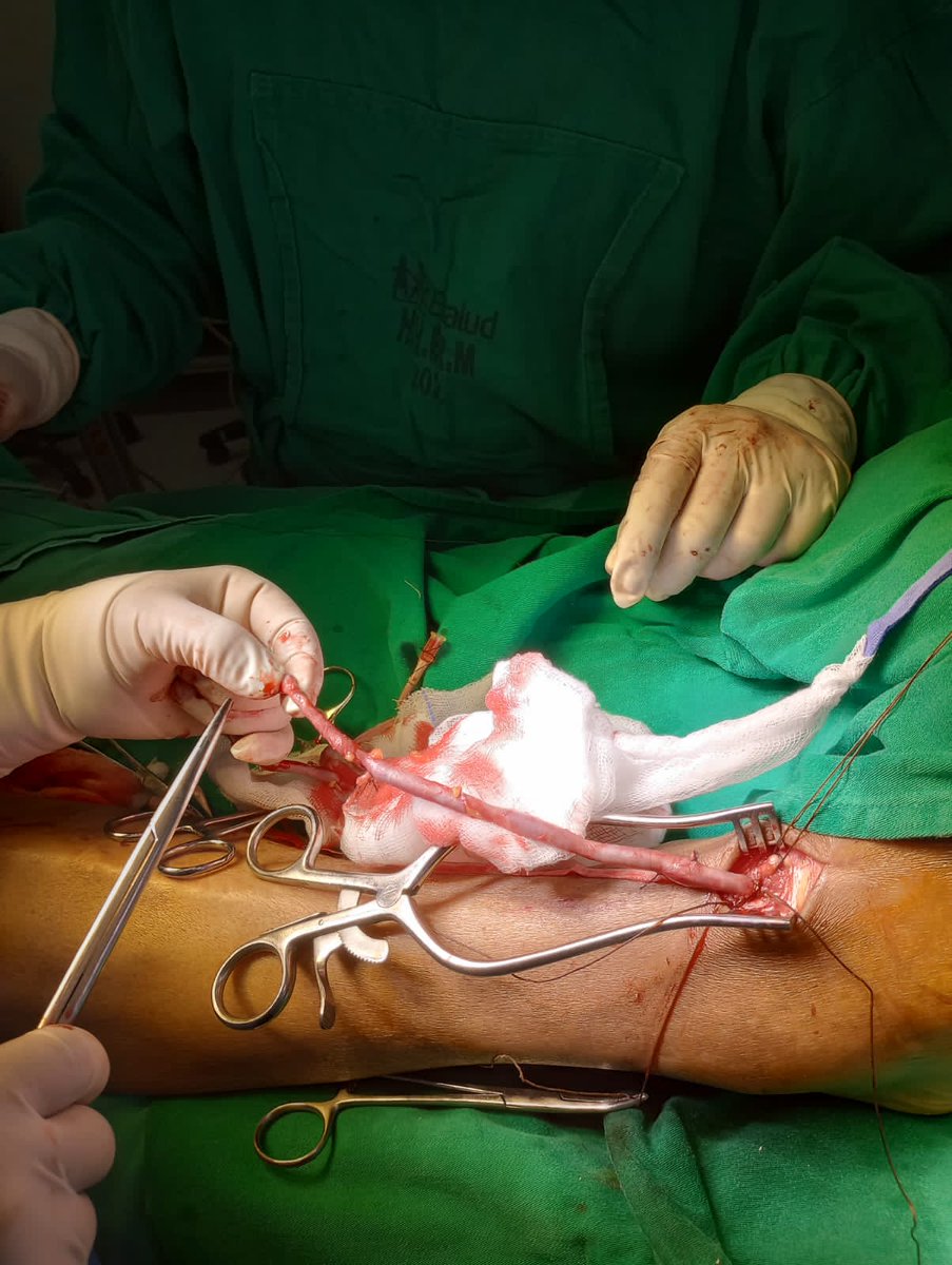 WildorSamir's tweet image. Popliteo pedal bypass, a useful surgical procedure in CLTI. The distal Bypass would be a crucial option in patients without a possibility of endovascular approach.

#CLTI🦶 #DistalBypass🦿 #OpenApproach🔥