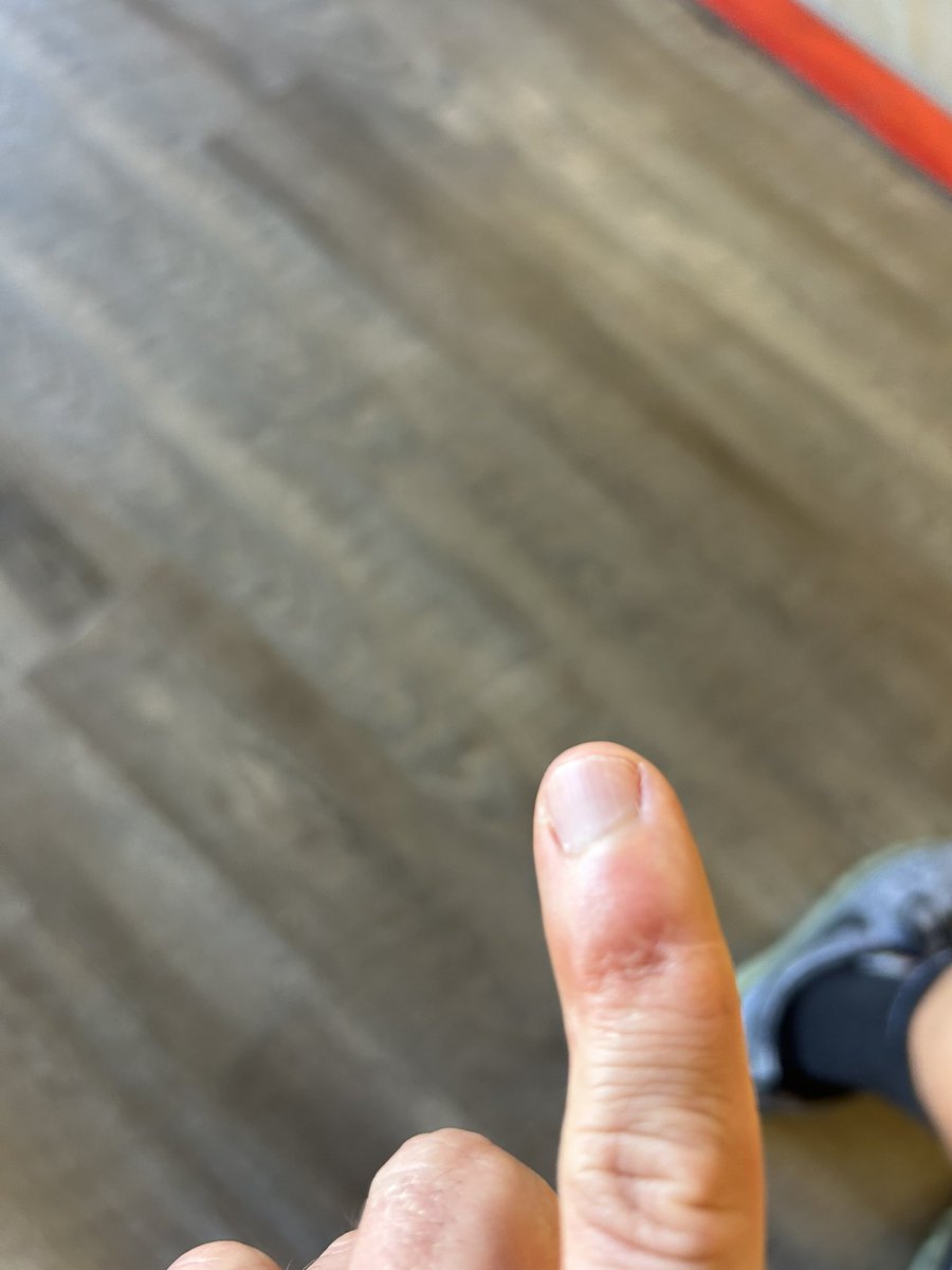 PappaFeez2's tweet photo. @oldwaver @TheHardline3to7 @corbydavidson @SportsSturm @MattBermingham @DJR1310 @KevLand13 In 4th grade my friend and I tried to cut a baseball open with a pocket knife. As I hammered the knife down into the baseball it (obviously) folded and nearly cut my pinky clean off. 9 stitches, wonky knuckle and 30 years later the scar is still noticeable. #scarbros https://t.co/8Vk9g4hHNV