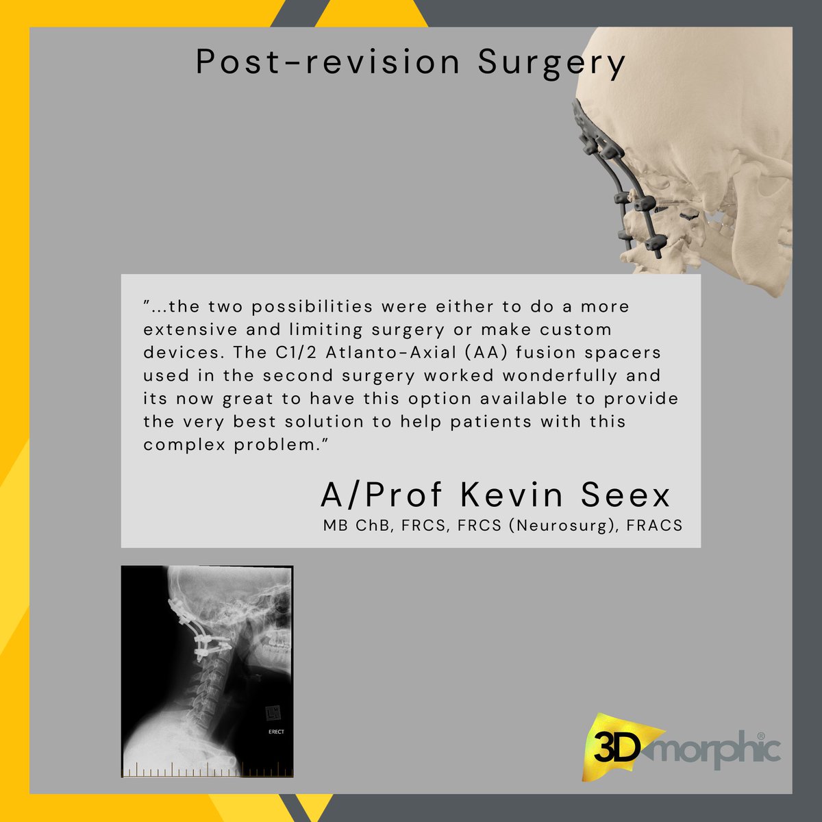 3DMorphic's tweet photo. 22yo underwent occipito-cervical fusion C0-C3 with conventional fixation. Initial surgery failed to relieve pain. Revision surgery with custom C1/C2 fusion devices by 3DMorphic was a successful solution and the patient improved considerably both in terms of alignment and fusion. https://t.co/yapX086YhL