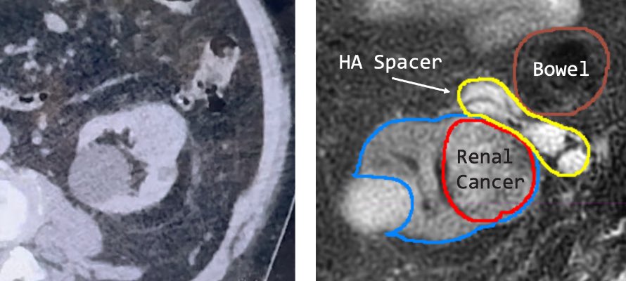 Proximity of large bowel would have made this renal SABR tricky. Hyaluronic Acid HA to the rescue with retroperitoneal spacing to facilitate stressless SABR. Life is indeed easier with HA. #radonc <a href="/Barrigel_spacer/">Barrigel</a>