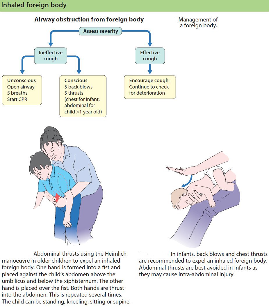 Top Biomedical Science (@imedverse) on Twitter photo Management of Airway obstruction from inhaled foreign body in children.
<a href="/ManualOMedicine/">Manual Of Medicine</a> #MedEd #MedX #pediatric Management of Airway obstruction from inhaled foreign body in children.
<a href="/ManualOMedicine/">Manual Of Medicine</a> #MedEd #MedX #pediatric