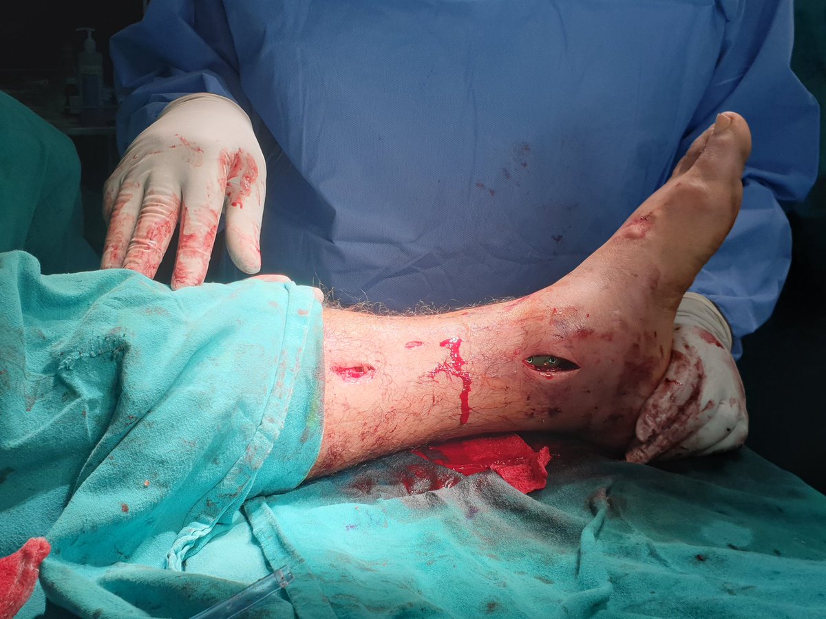 ORTHODOC1234's tweet photo. @InvictaOrtho @OrthoTwiter The implants are standaed AO ones ...LCP 
The distal medial tibia is done through a MIPPO technique so no chances of wound dehisence..👍 https://t.co/u9fQALF6fe