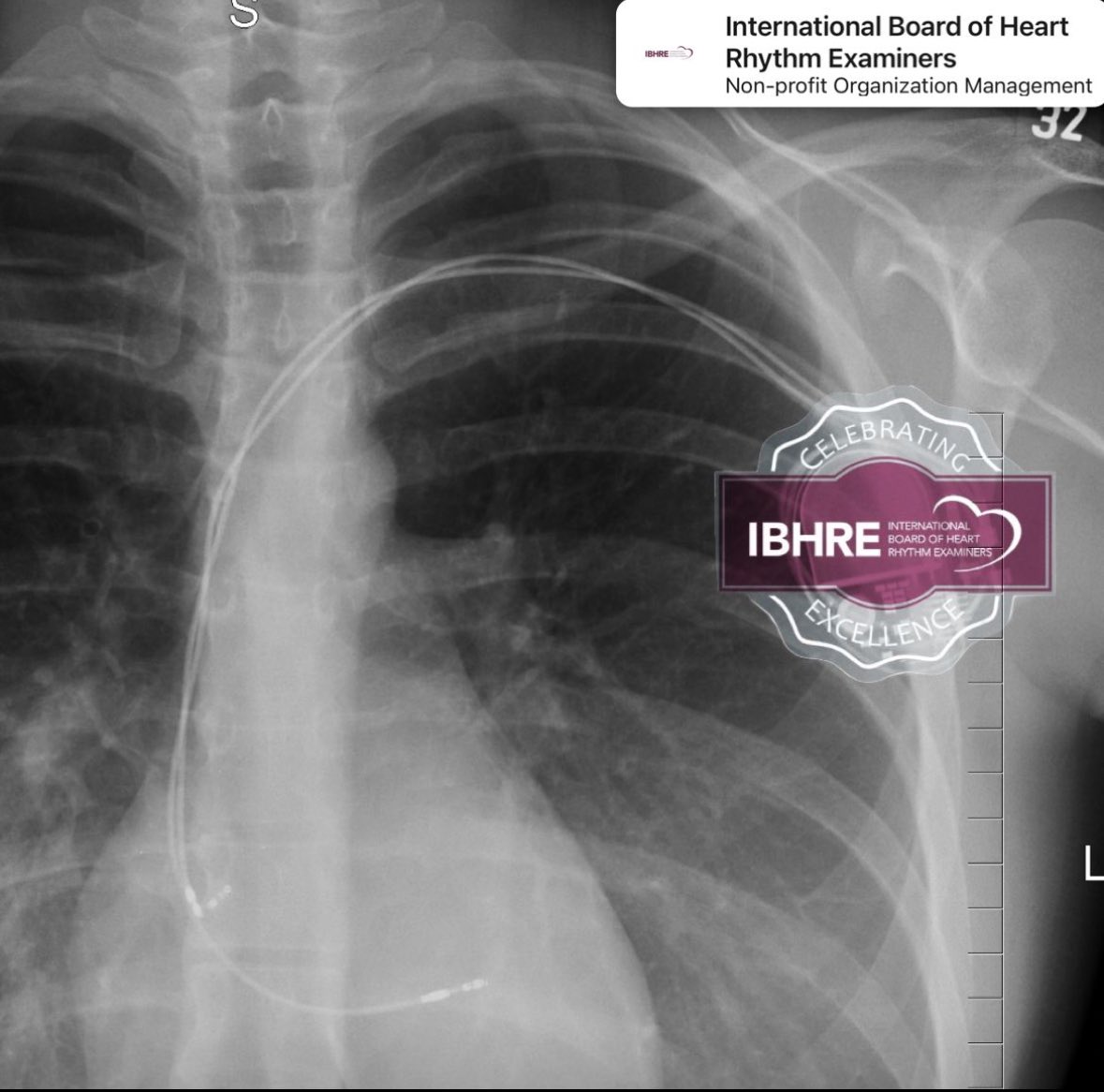 Today (Feb 14) marks 6 years since my last lead extraction, 2 days after #IBHREDAY. Their closeness is symbolic to me as my advocacy of IBHRE certification comes from both my experience as a health profession and as a patient. #epeeps