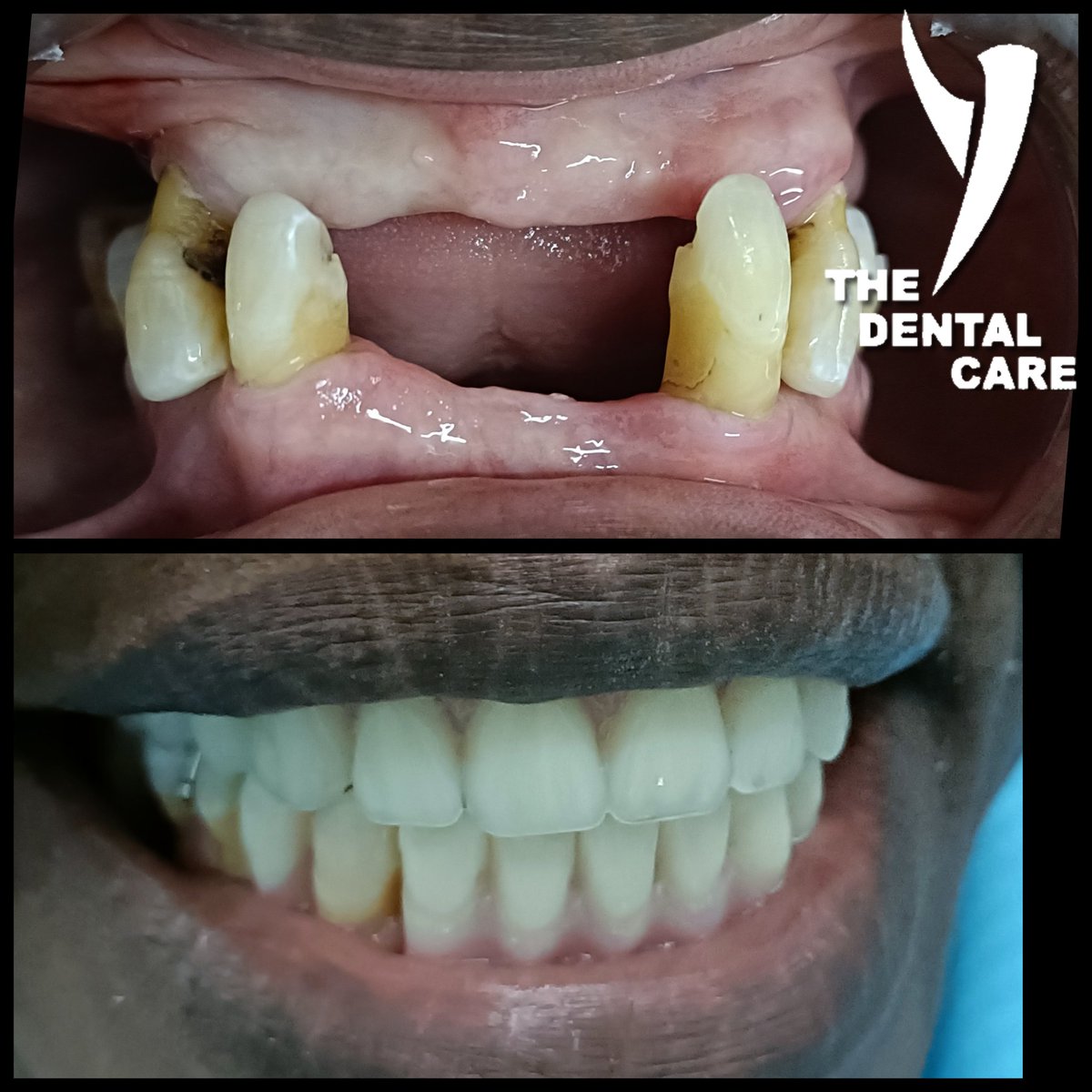'Elderly receiving teeth isn't just about appearance. Proper chewing ensures better digestion, nutrient absorption, and prevents issues like indigestion and flatulence. #OralHealth #ElderlyCare 🦷💪'sekodental.co.za