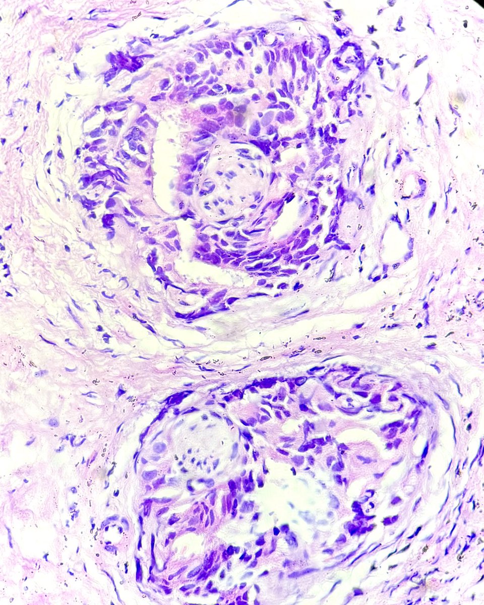 Perineural invasion are so pretty to look at in #prostaticadenocarcinoma 
#pathX #pathology #pathresidents #GUTpath