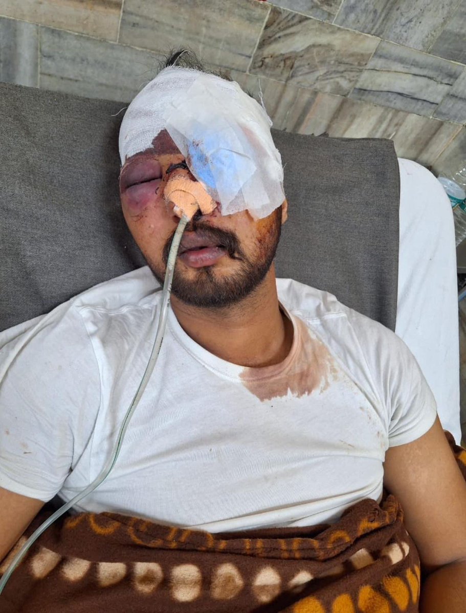 ਪਿੰਡ ਹਰਪਾਲਪੁਰ ਤੋਂ ਬਾਈ ਦਵਿੰਦਰ ਸਿੰਘ ਭੰਗੂ ਦੇ ਕੱਲ ਸ਼ਾਮ ਸੰਭੂ ਮੋਰਚੇ ਵਿਚ ਸਿੱਧਾ ਮੂੰਹ ਉਪਰ ਅੱਥਰੂ ਗੈਸ ਦਾ ਗੋਲਾ ਡਿੱਗਣ ਕਾਰਨ ਦਵਿੰਦਰ ਭੰਗੂ ਗੰਭੀਰ ਜਖਮੀ ਹੋ ਗਿਆ ਹੈ ਇਕ ਅੱਖ ਨੁਕਸਾਨੀ ਗਈ ਹੈ।
#farmersprotest
#shambubarrier