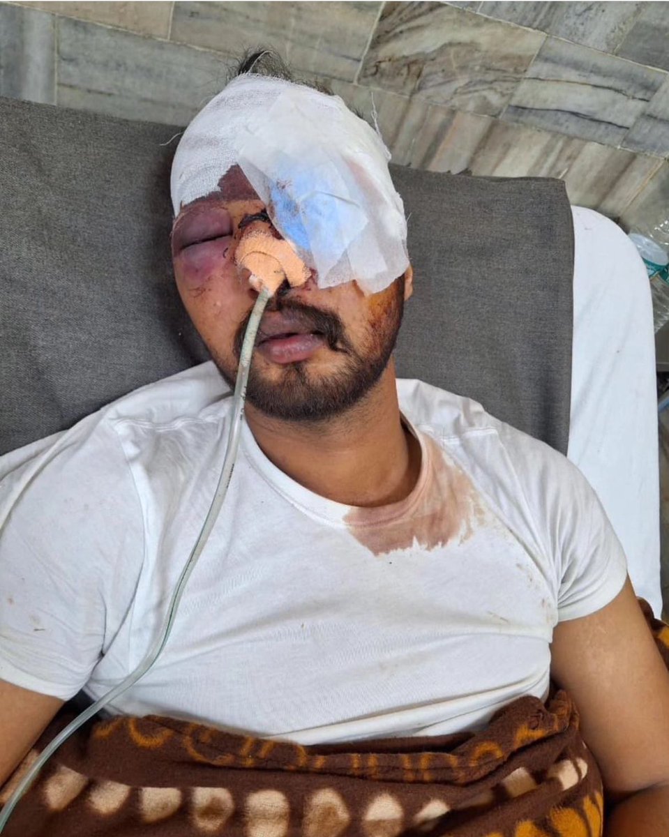 Harpreet Singh Hora (@harpreet_s_hora) on Twitter photo Davinder Singh Bhangu a farmer from village Harlapur has been seriously injured , as tear gas directly hit him on his face yesterday, he lost his eye <a href="/AbhaysherMann/">Abhay Sher Singh Mann (Talanian)</a> <a href="/ishar_adv/">Harinder Pal Singh Ishar</a> <a href="/HartoshSinghBal/">Hartosh Singh Bal</a> <a href="/rwac48/">Lt Gen H S Panag(R)</a> <a href="/mandeeppunia1/">Mandeep Punia</a> <a href="/sikh_coalition/">Sikh Coalition</a> <a href="/WorldSikhOrg/">WSO</a> <a href="/sikhexpo/">Sikhexpo</a> <a href="/SikhNewsExpress/">Sikh News Express</a> Davinder Singh Bhangu a farmer from village Harlapur has been seriously injured , as tear gas directly hit him on his face yesterday, he lost his eye <a href="/AbhaysherMann/">Abhay Sher Singh Mann (Talanian)</a> <a href="/ishar_adv/">Harinder Pal Singh Ishar</a> <a href="/HartoshSinghBal/">Hartosh Singh Bal</a> <a href="/rwac48/">Lt Gen H S Panag(R)</a> <a href="/mandeeppunia1/">Mandeep Punia</a> <a href="/sikh_coalition/">Sikh Coalition</a> <a href="/WorldSikhOrg/">WSO</a> <a href="/sikhexpo/">Sikhexpo</a> <a href="/SikhNewsExpress/">Sikh News Express</a>