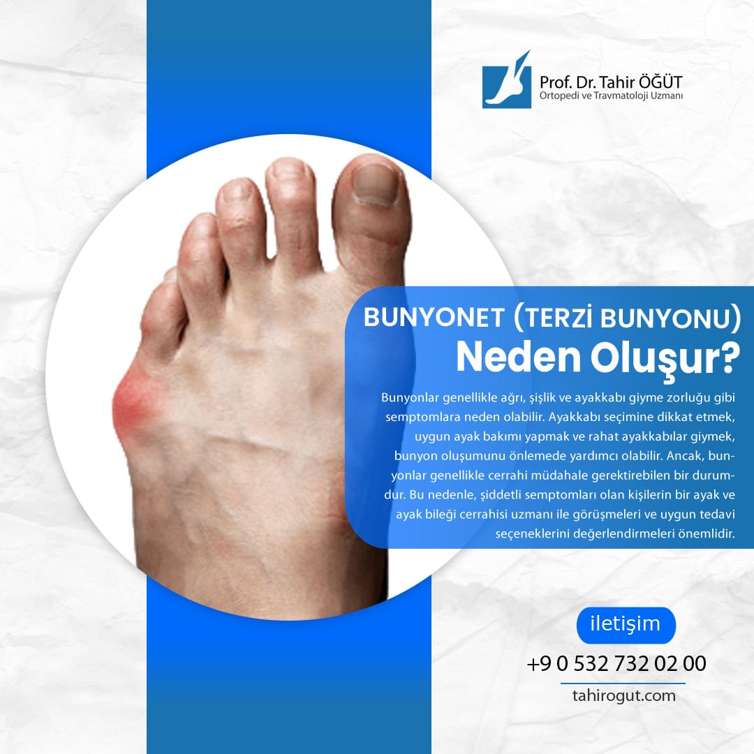 drtahirogut's tweet photo. Bunyonet (Terzi Bunyonu) Neden Oluşur❓

• Genetik Yatkınlık
• Ayakkabı Seçimi
• Romatoid Artrit veya Diğer Eklem Sorunları
• Hormonal Değişiklikler

#bunyonet #bunyonettedavisi #terzibunyonu #bunionette #bunionettetedavisi #ayakveayakbilegicerrahi #profdrtahiröğüt https://t.co/SpsWRtoYO2