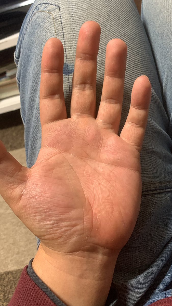 temcas10101989's tweet photo. 病院にコロナの再検査行ったら、看護婦のお姉さんに手相見られてﾋｲｯ…みたいな感じで後退りされたのですが手相マニアおりませんか？ https://t.co/yMAOGMwkJ5