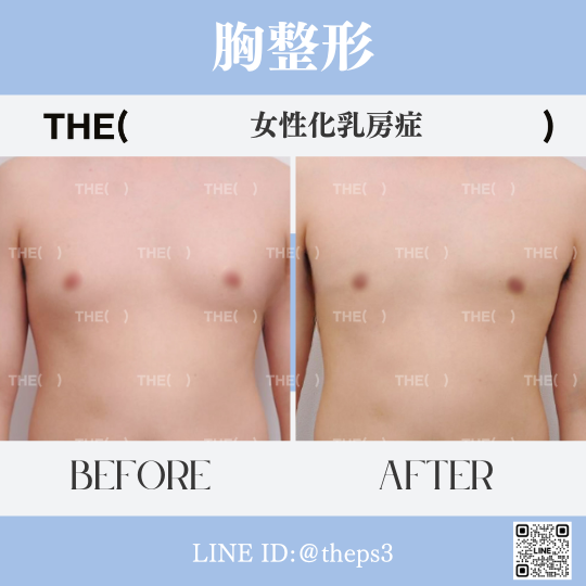 JapanTheps's tweet photo. THE(　) #女性化乳房症

(🔹)女性化乳房症　＊3ヶ月経過
執刀医🥼キム・セヨン院長

お問い合わせは公式LINEまで♫
🔗 https://t.co/TgRGzWGzFA
🆔 @theps3　

#韓国 #THE美容外科 #ザ美容外科 #整形 #男性整形 #胸整形 #渡韓整形 #症���写真 https://t.co/mLiQF2m9GH