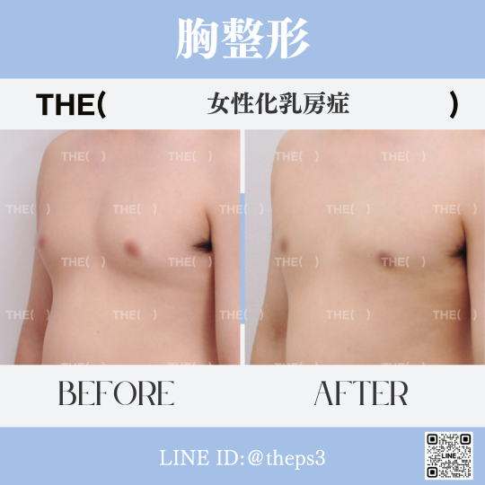 JapanTheps's tweet photo. THE(　) #女性化乳房症

(🔹)女性化乳房症　＊3ヶ月経過
執刀医🥼キム・セヨン院長

お問い合わせは公式LINEまで♫
🔗 https://t.co/TgRGzWGzFA
🆔 @theps3　

#韓国 #THE美容外科 #ザ美容外科 #整形 #男性整形 #胸整形 #渡韓整形 #症���写真 https://t.co/mLiQF2m9GH