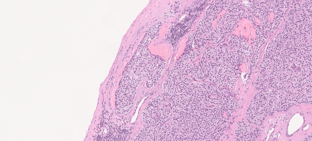DrJuhlin's tweet photo. You might know a thing or two about hepatic peliosis, but did you know that extravasation of erythrocytes is also common in parathyroid tumors? This may cause diagnostic confusion, as the condition may mimic V1. 

Some helpful tips follow in a mini-thread: https://t.co/p7fkcq7ywl