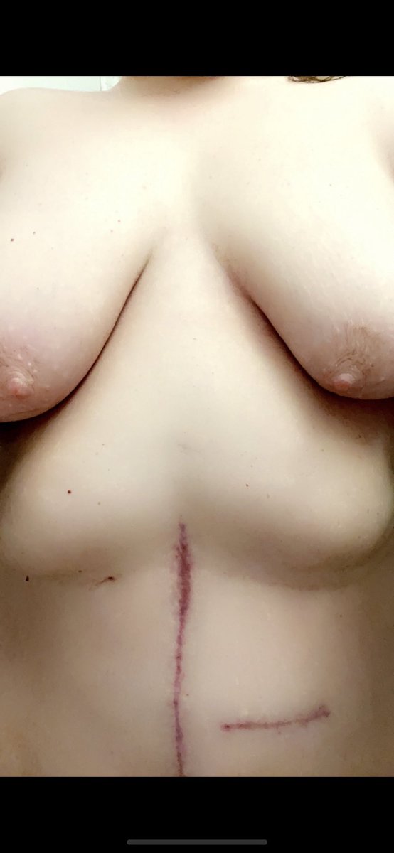 lexiimae1990's tweet photo. @KreamPieKat @ralf23883 I’m very self conscious now of mine bc I had major surgery in sept, but here it goes https://t.co/6egJB6YGvY