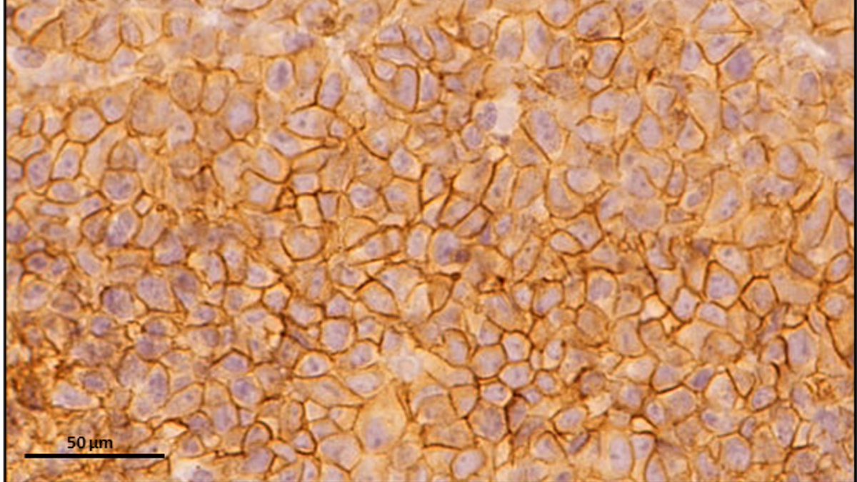 SaludISCIII's tweet photo. 🗓️ Hoy es el #DíaInternacionalCáncerInfantil.

📍 El #ISCIII ha reforzado su investigación en cáncer pediátrico raro con un proyecto de terapias avanzadas en sarcoma de Ewing.

📰 Más información en #NoticiasISCIII ➡️ https://t.co/GctSgdrg5q https://t.co/ysRdc0nxOg