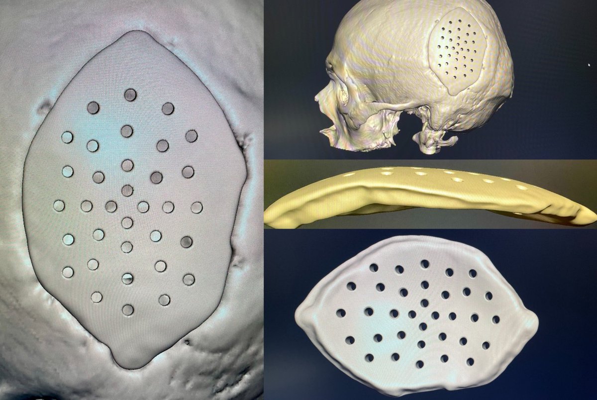 MarWatPoz's tweet photo. @TTTeatrzyk Dzień dobry. Gotowy jest projekt implantu na 2 zabieg. Teraz wydruk, sterylizacja i dostawa do kliniki. Zabieg nr 2 jeszcze w lutym. 💪 https://t.co/dKmDO49vZw