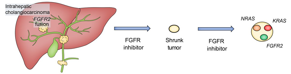 Convergent MAPK pathway alterations mediate acquired resistance to FGFR inhibitors in FGFR2 fusion-positive #cholangiocarcinoma Full text here👉journal-of-hepatology.eu/article/S0168-… @TDiPeriMD @MDAndersonNews #LiverTwitter
