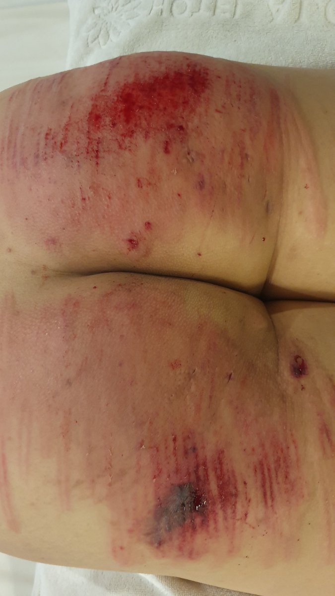 간만에 즐거운 플이였다. 다음에는 더 길고 굵은(?)걸로도 해보고 싶음 ㅎㅎ #스팽 #멜투멜 #구인 #체벌 #케인