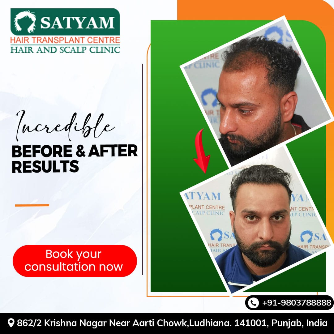 Say goodbye to hair loss worries and hello to a new you. Book your consultation today and embark on your journey to hair restoration excellence.

☎️ - 9988491800,9803788888
🌐 satyamhairtransplantindia.in

#hair #hairtreatment #prphair #hairgraft #hairtransplant #satyamhairtransplant