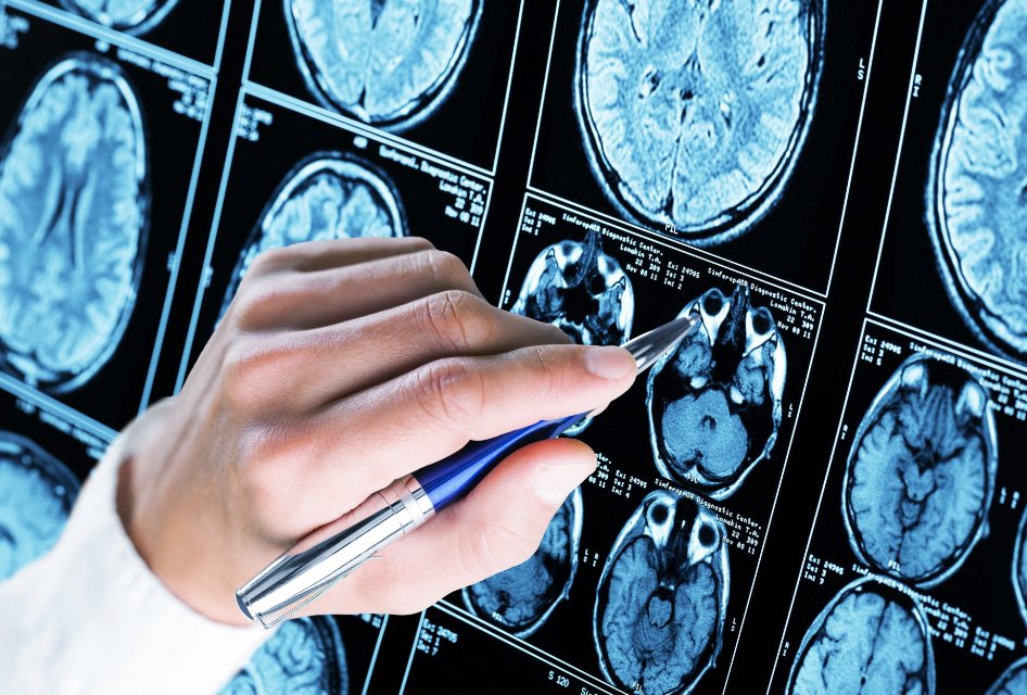 Biogen will advance its research on lecanemab-irmb, BIIB080, and BIIB113 for the treatment of Alzheimer disease. However, they will discontinue the development and commercialization of aducanumab. Click the link to learn why. bit.ly/3OB1Nun