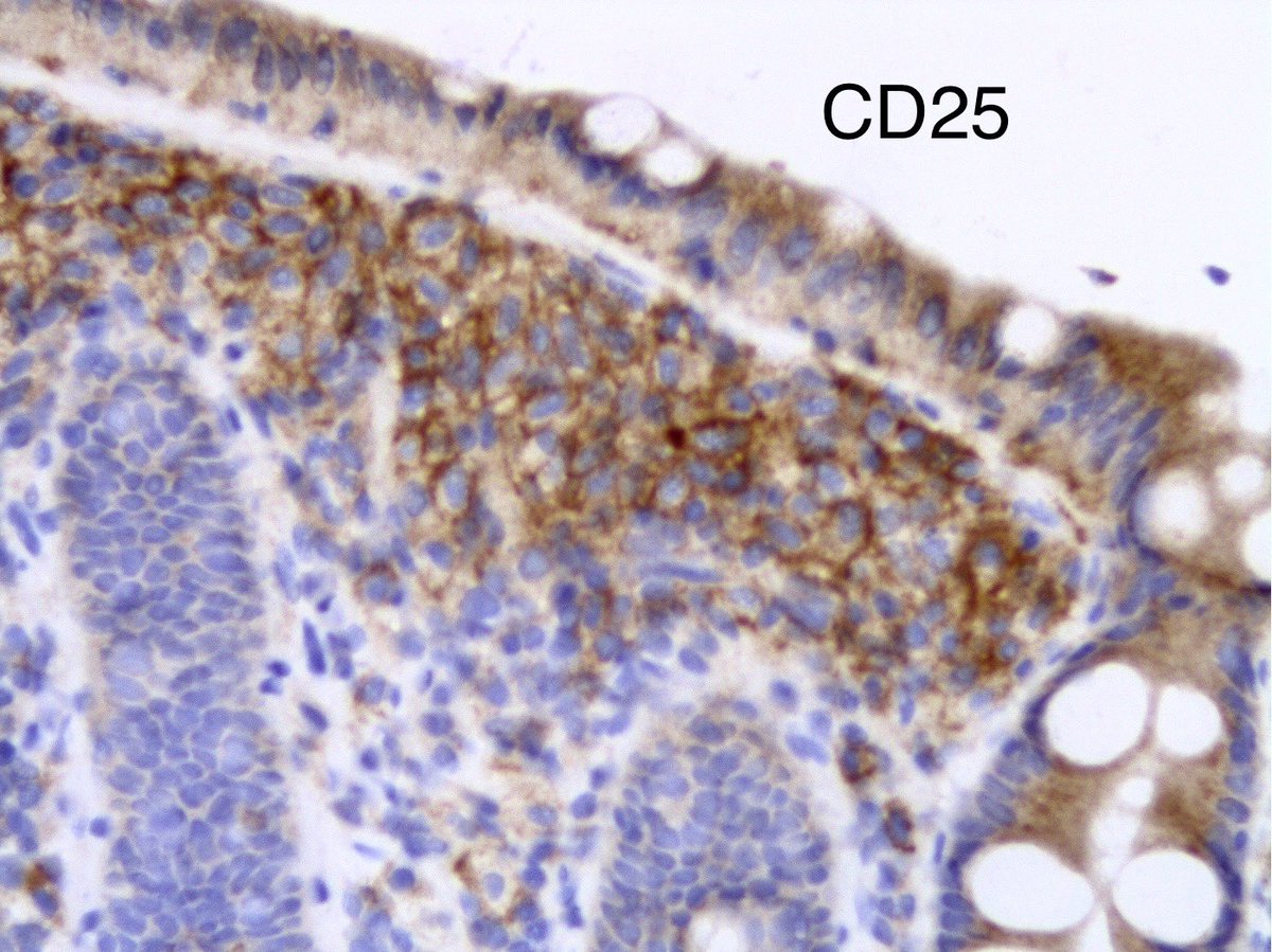 Cd117 highlights mast cells . Cd25 is also abnormally positive. Case of systemic mastocytosis.