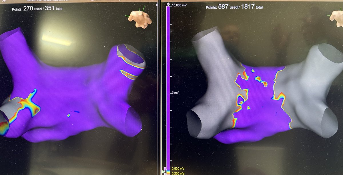 First commercial case with the FARAPULSE system at @StBernards . NO fluoroscopy use , ICE for contact assessment and an incredible team makes for a great case.#Safetyfirst #paradigmshift #epeeps @WomenAs1 @BSCCardiology #ArrhythmiaResearchGroup @HRSonline