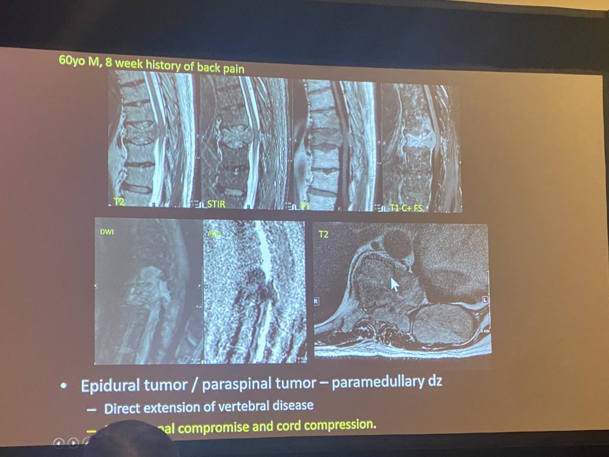 Dr. Aggarwal discusses hematologic malignancies - what happens in the spine doesn’t always stay in the spine #ASSR24