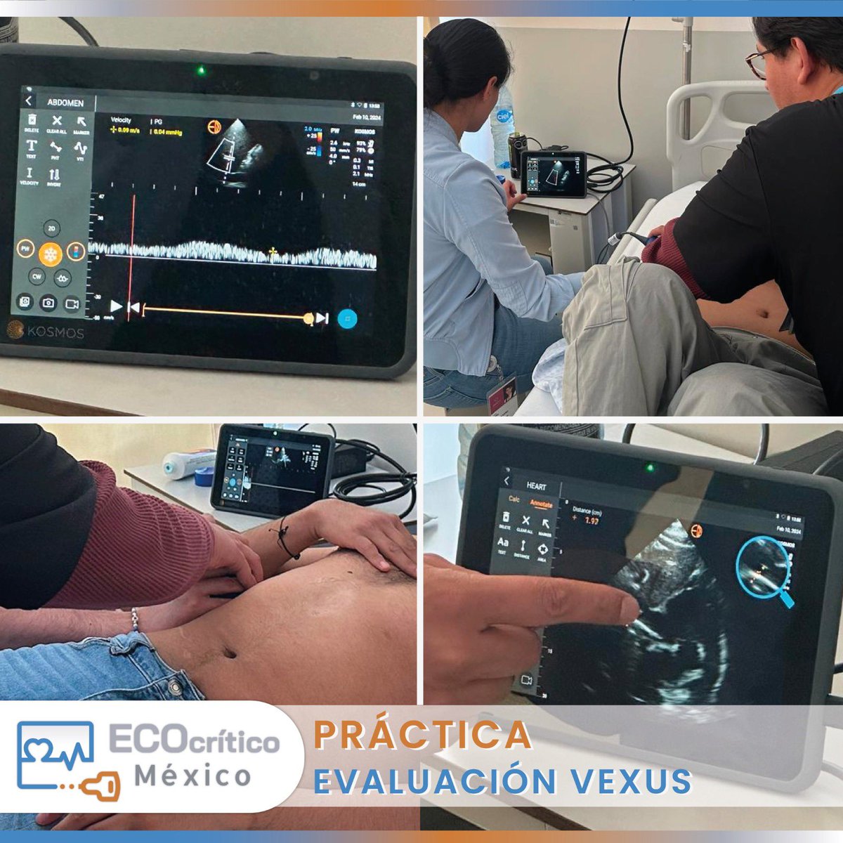 En nuestro pasado curso practicamos la valoración VExUS para el beneficio de los pacientes en el Hospital General ISSSTE Tláhuac!! @KosmosLatAm @ecocritico_UTIC @SISIACOficial @SIAC_cardio