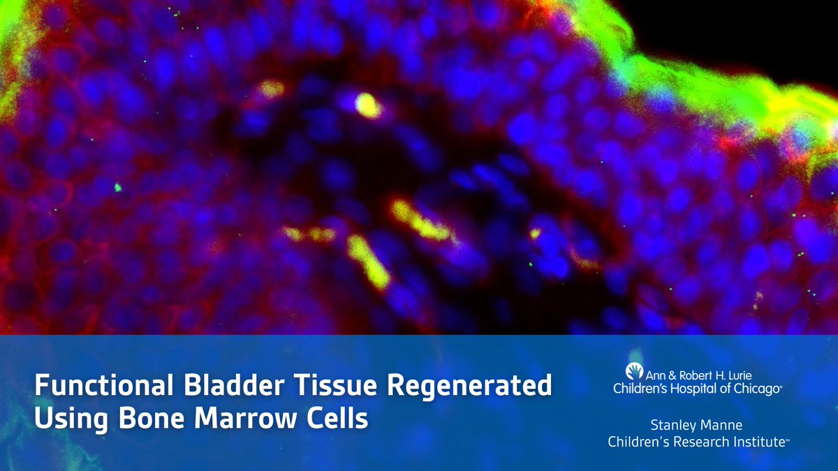 Long-term study by the Sharma (Arun) Laboratory succeeds in regenerating functional bladder tissues, opening the door to better treatments for kids with spina bifida and severe bladder dysfunction. luriechildrens.org/en/news-storie… @LurieChildrens @NUFeinbergMed @PNASNexus #research
