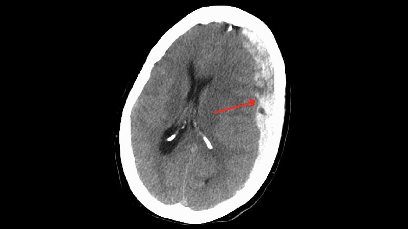 The treatment of a subdural hematoma received a major boost with three new randomized controlled trials all showing large and significant benefits of a new embolization process done as an endovascular procedure, reducing the need for surgery. #ISC24 ms.spr.ly/6016cDQsq