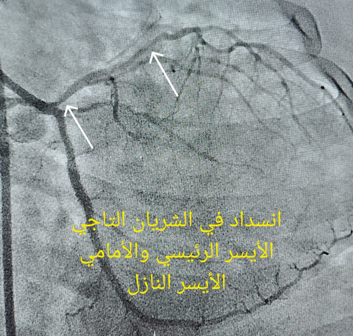 Zayer_h's tweet photo. Making Arteries Great Again 👍
Surgical turn down treated with image guided #PCI of the LM into LAD with 3 overlapping stents.
Thanks to our fantastic cath lab staff 👏
"No I in Team" 🙏
#PrecisionPCI
#RadialFirst
#CHIP https://t.co/LUP1C29Lr9