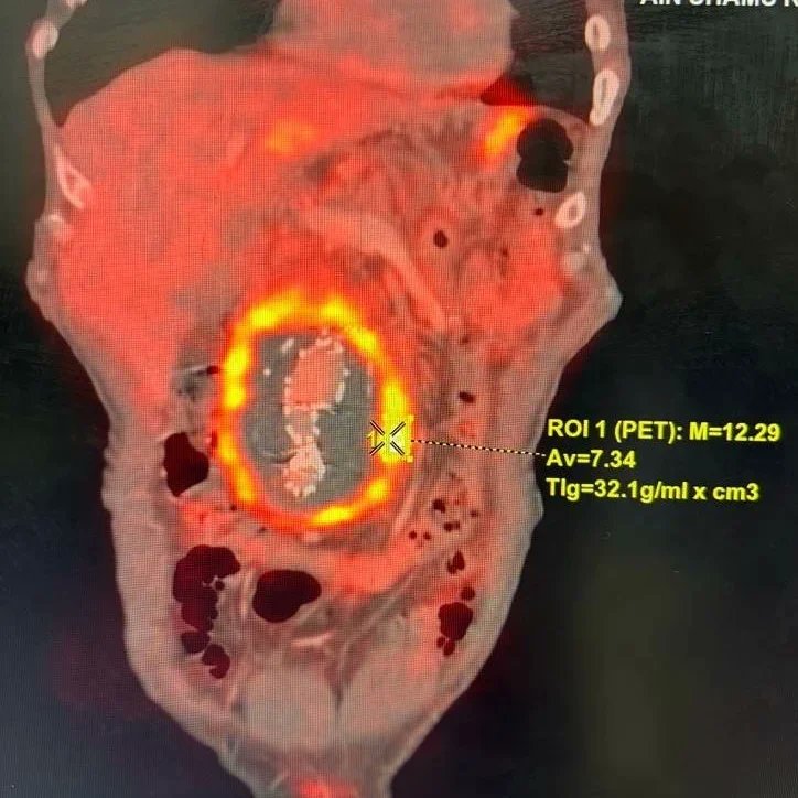 asunirad's tweet photo. What's Wrong with this
PET/CT scan??
#Caseofthemonth

That's a 63 year old male patient, who came with abdominal pain and elevated CRP after AAA repair by EVAR 1 year ago.

Look at the PET/CT scan try to reach a diagnosis yourself.

#radres #radiology #nuclearmedicine https://t.co/toq6l4k1tP