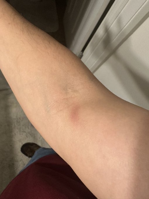 If anyone follows..you know I&rsquo;ve been having trouble with my arm. Just an update now bruising is visible<a href="/tag/mvsales"class="tags"><span>#mvsales</span></a>