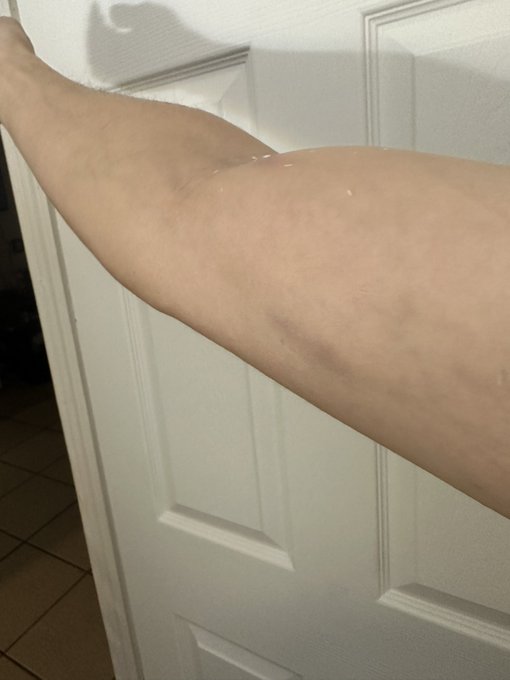 If anyone follows..you know I&rsquo;ve been having trouble with my arm. Just an update now bruising is visible<a href="/tag/mvsales"class="tags"><span>#mvsales</span></a>