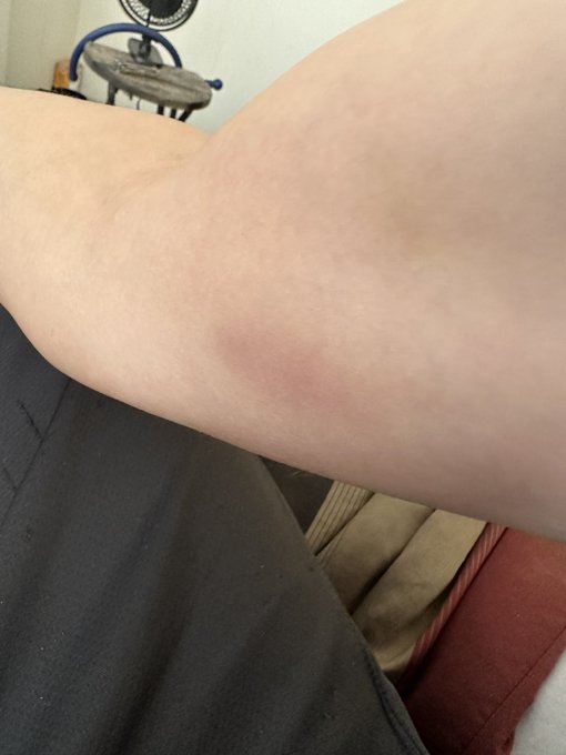 If anyone follows..you know I&rsquo;ve been having trouble with my arm. Just an update now bruising is visible<a href="/tag/mvsales"class="tags"><span>#mvsales</span></a>