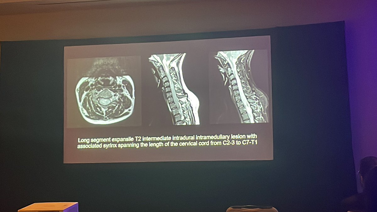 American Society of Spine Radiology (ASSR) (@the_assr) on Twitter photo Drs. Hector Banchs Vinas & <a href="/AsheshThaker/">Ashesh Thaker</a> discussing interesting tumors imaging in Spine Tumor Case Conference
#ASSR24 #twittertakeover <a href="/SandraAbiFadel1/">Sandra Abi Fadel</a> Drs. Hector Banchs Vinas & <a href="/AsheshThaker/">Ashesh Thaker</a> discussing interesting tumors imaging in Spine Tumor Case Conference
#ASSR24 #twittertakeover <a href="/SandraAbiFadel1/">Sandra Abi Fadel</a>