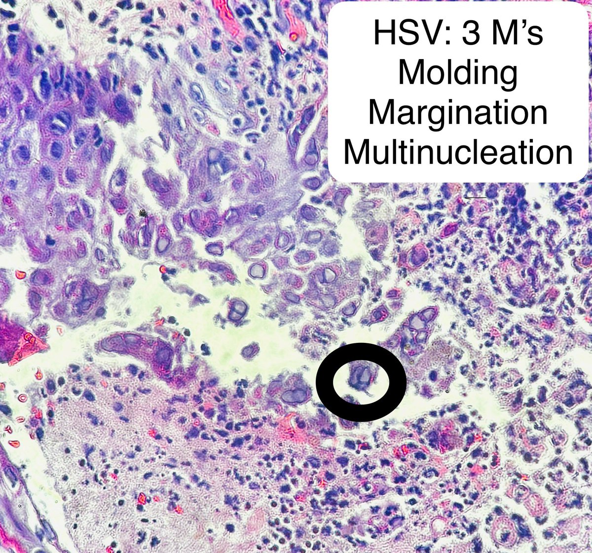 More for the pathology residents, non path residents, and med students:

Remember the 3 M’s!

Molding
Margination
Multinucleation

Here we have HSV infection of the skin

#pathagonia #pathx #medstudent #medstudentx #pathology #hsv #medx #infectiousdisease #surgpath #herpes