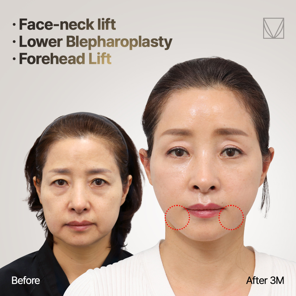 🩵Can you see this big improvement?🩵

#facelifting #necklift #blepharoplasty #eyesurgery #browlifting #undereyebags
#eyelidlift #saggy #droopyeyes #faceliftsurgery  #koreanplasticsurgery #boardcertifiedplasticsurgeon #facialplasticsurgery