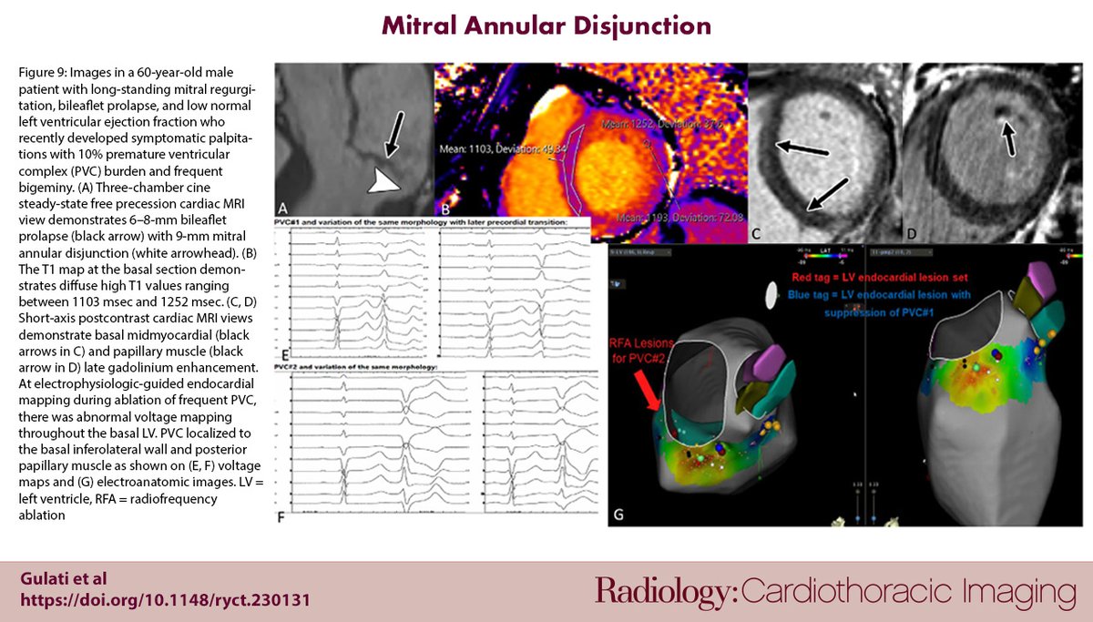 NEW PODCAST EP 🎙️Mitral Annular Disjunction Host @PraveenRangana9 chats with Dr. Gulati, Dr. Pavri, and Dr. Sundaram about their recently-published review on mitral annular disjunction -- tune in and enjoy! Podcast⛓️rsnaradiologycti.libsyn.com/episode-23-mit… Paper⛓️pubs.rsna.org/doi/10.1148/ry…