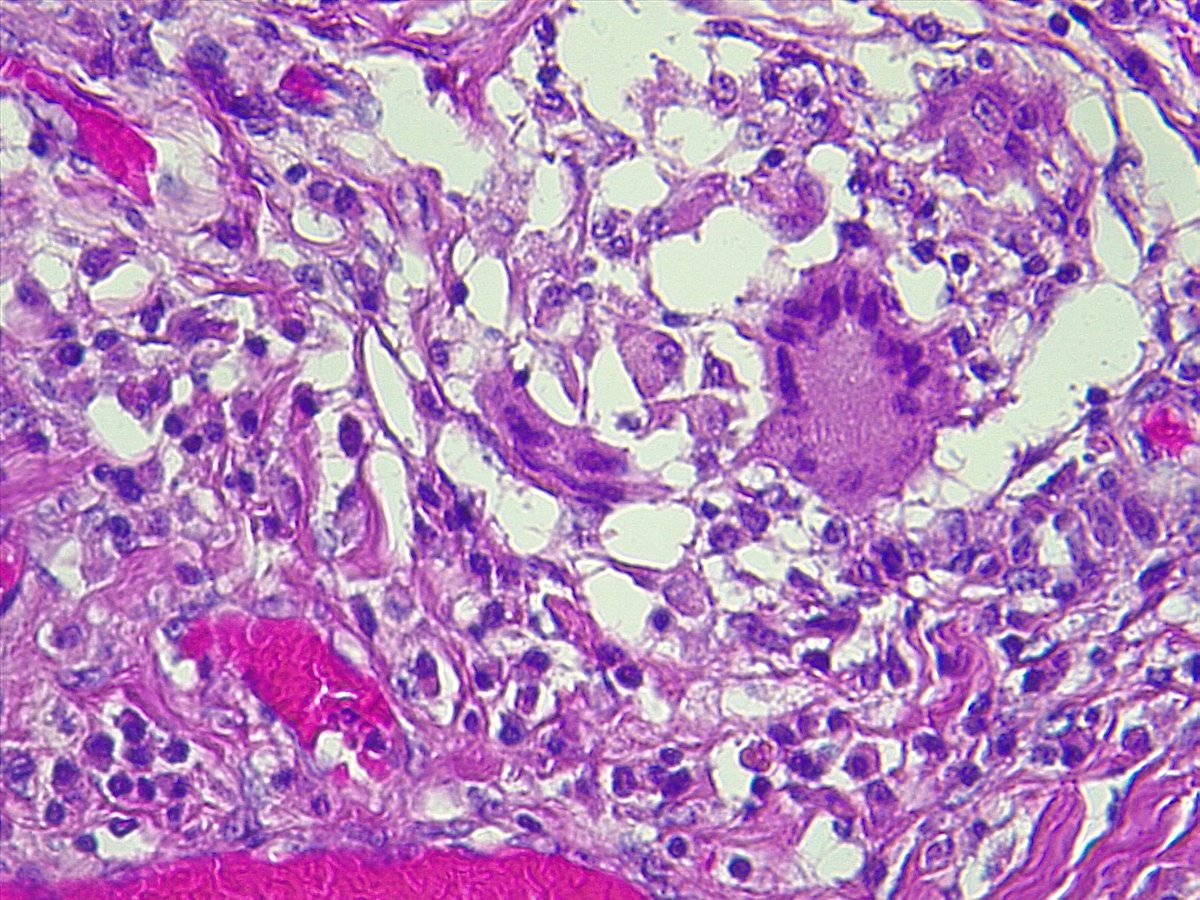 Omentum. Male 23yo #GIPath #Granuloma