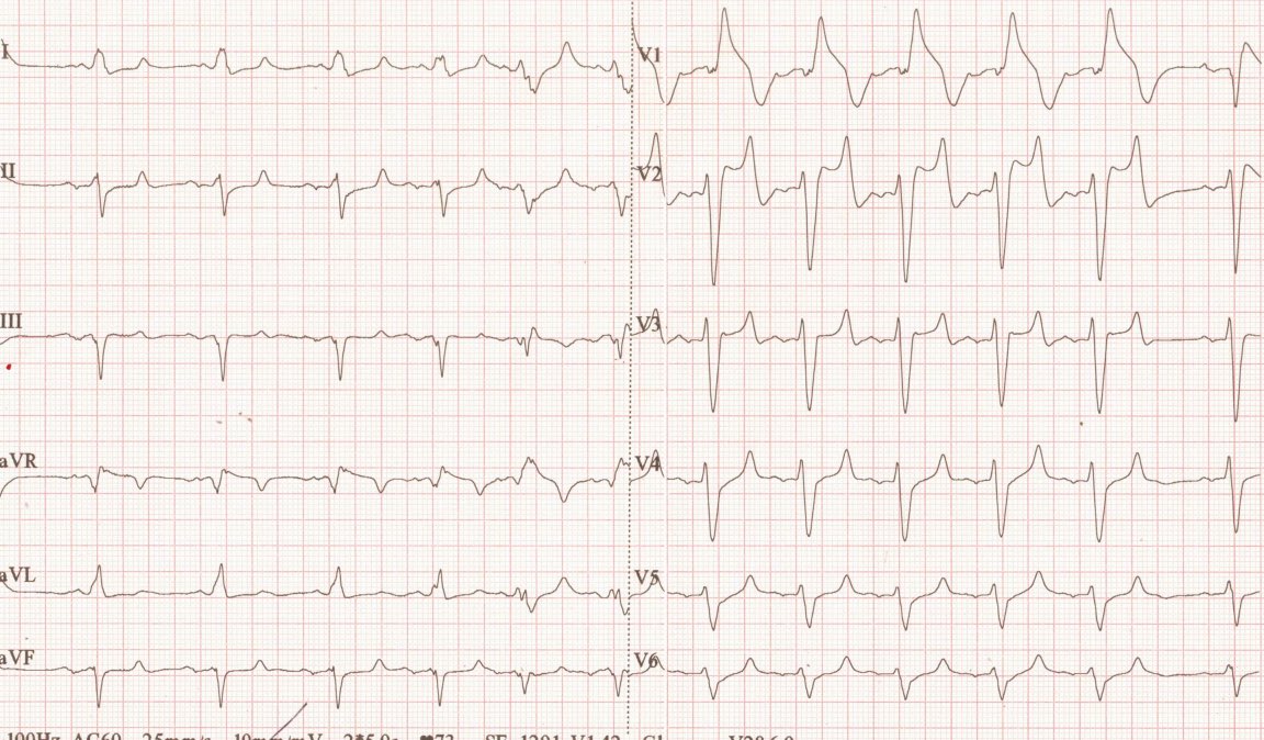 Thoughts on these ECGs please. 59 years old female, sudden collapsed and unresponsive. ECGs 20 minutes apart. Went into VT after and shocked x4. @ECGfan @ecgandrhythmRoe @ecgrhythms @EcgsOnly @BrooksWalsh