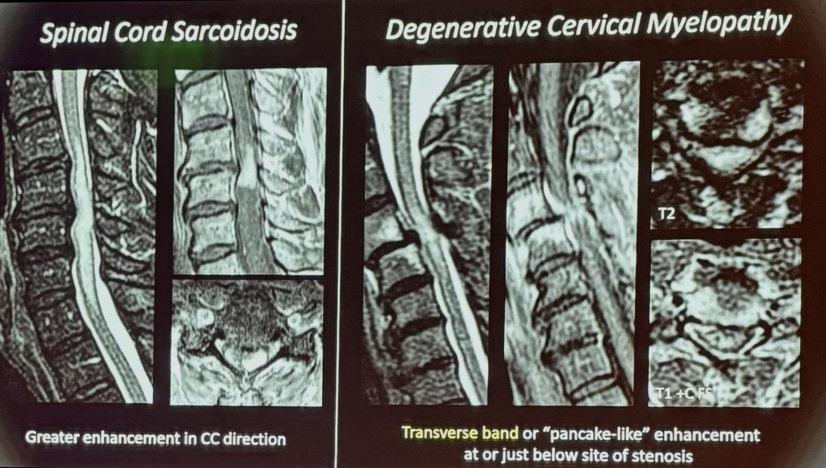 Love to see these two pathologies compared side by side— Degenerative compressive myelopathy is an important one to recognize. 

Great job to Joon Soo Shin MD, @EricTranvinhMD and all the fellows in the 
Mentored Case Session at #ASSR24