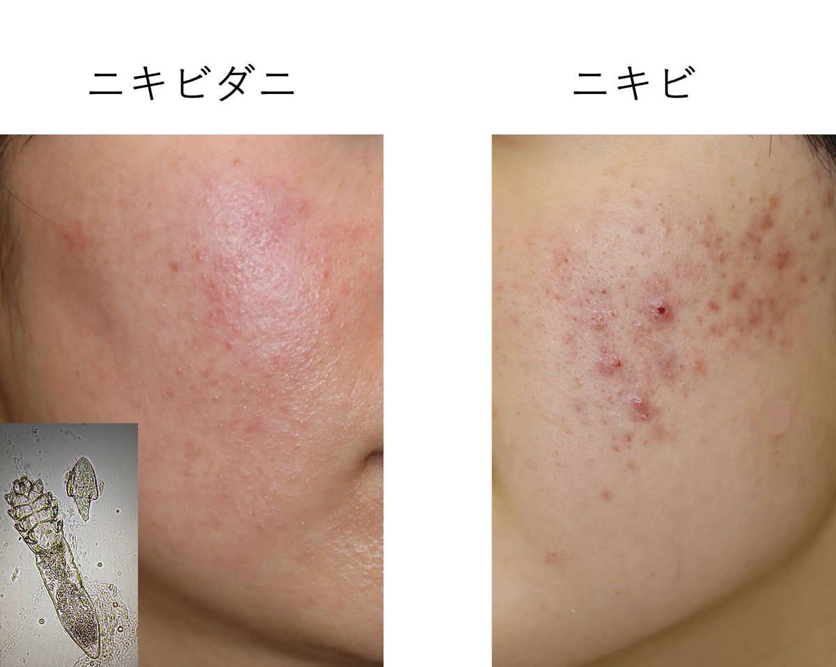 Anjosakuracl's tweet photo. ニキビダニと普通のニキビ。ニキビの塗り薬で治らないとか、少しむず痒いなと感じたらニキビダニかも。 https://t.co/mJuczqIeWa
