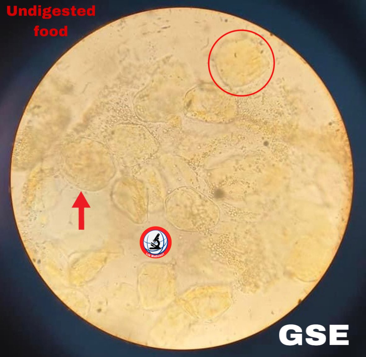 Lab_Medicine1's tweet image. #gse #GSE #undigested food youtube.com/@Lab_Medicine1